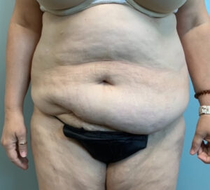 Abdominoplasty