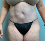 Abdominoplasty