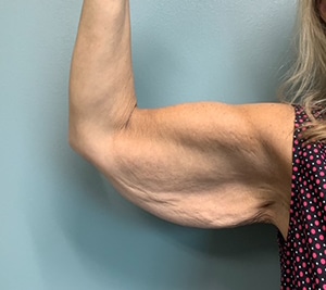 Arm Lift Before & After Pictures