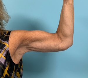 Arm Lift Before & After Pictures