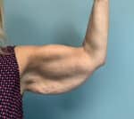 Arm Lift Before & After Pictures
