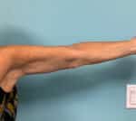 Arm Lift Before & After Pictures