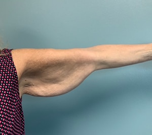 Arm Lift Before & After Pictures