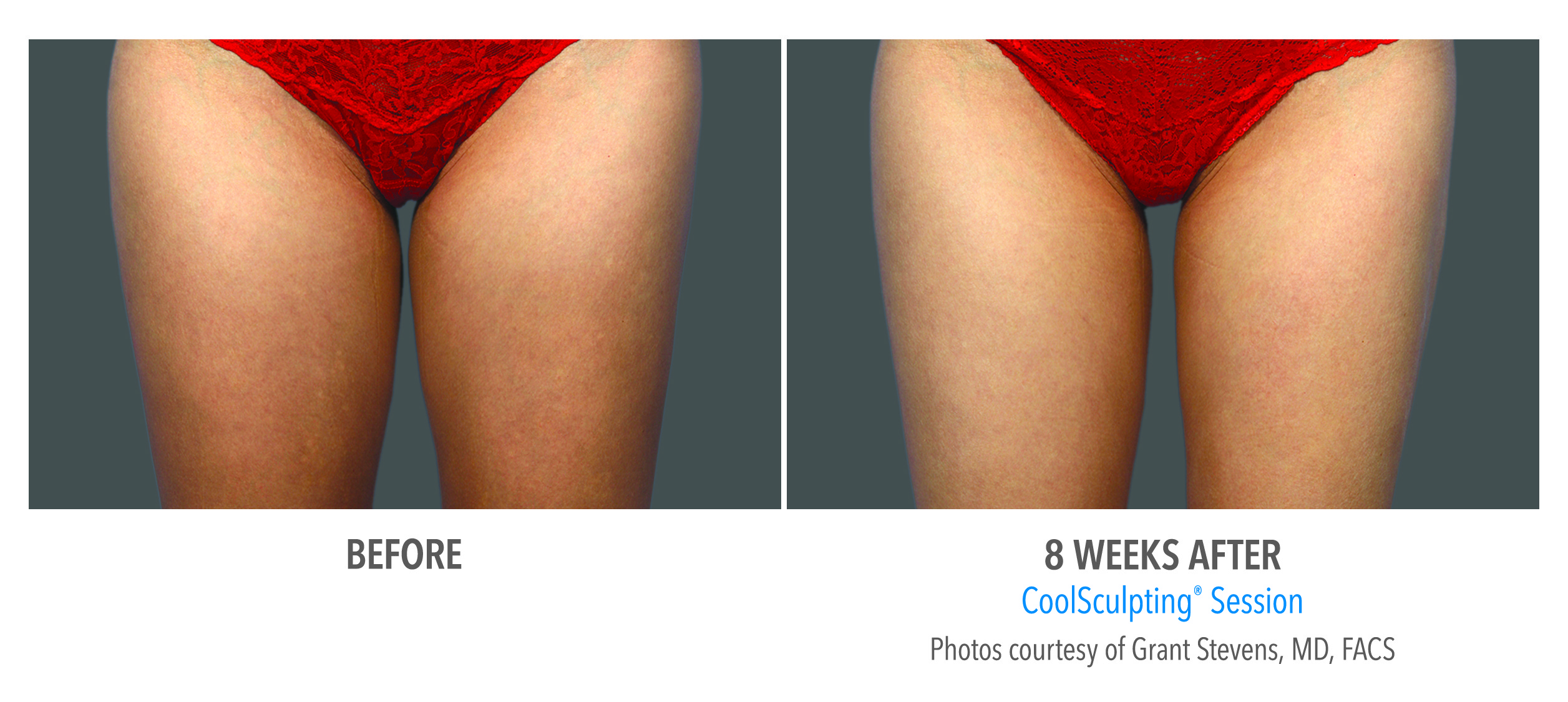 Coolsculpting of the thighs can show significant results up to 8 weeks.