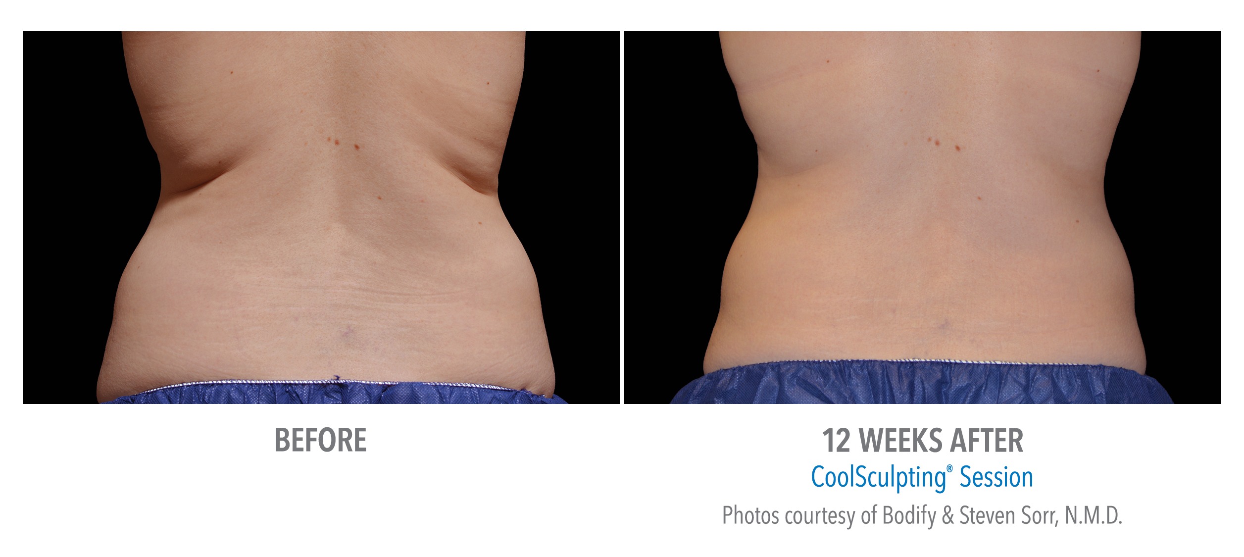 Coolsculpting shows positive results in 12 weeks or less!
