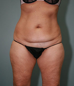Abdominoplasty or Tummy Tuck Results Detroit